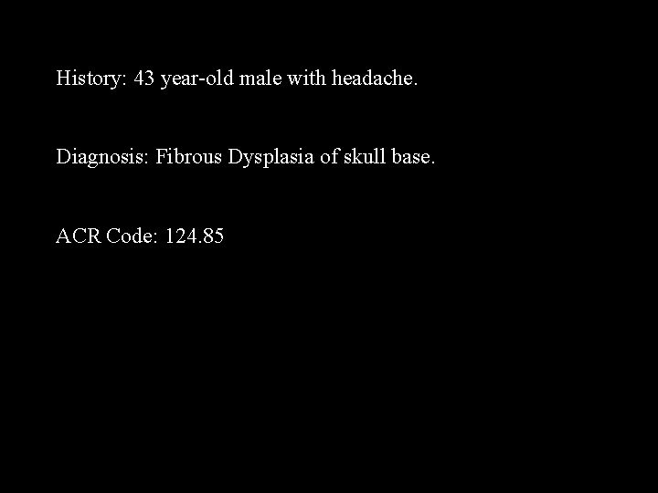 History: 43 year-old male with headache. Diagnosis: Fibrous Dysplasia of skull base. ACR Code: