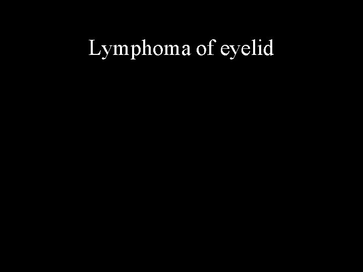 Lymphoma of eyelid 