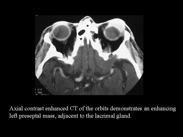 Axial contrast enhanced CT of the orbits demonstrates an enhancing left preseptal mass, adjacent