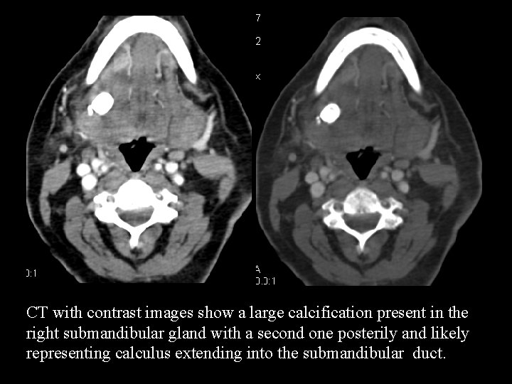 CT with contrast images show a large calcification present in the right submandibular gland