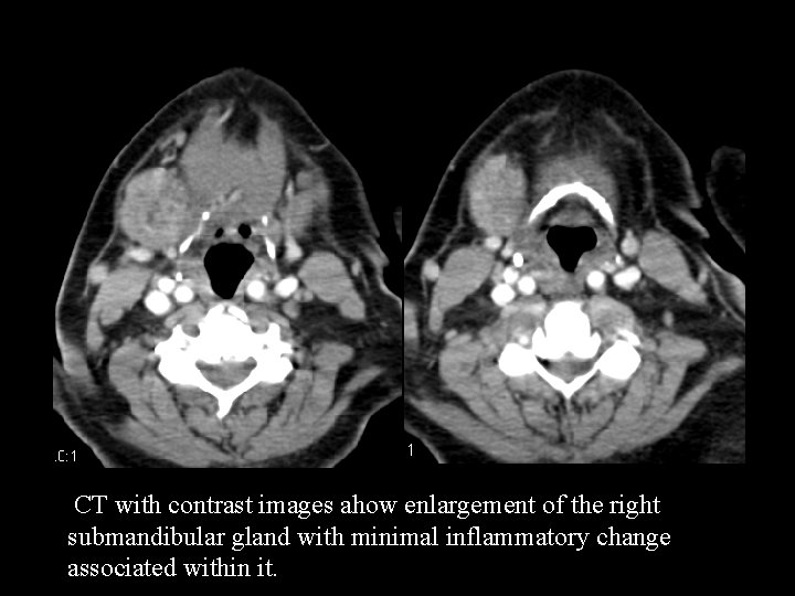  CT with contrast images ahow enlargement of the right submandibular gland with minimal