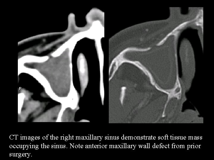 CT images of the right maxillary sinus demonstrate soft tissue mass occupying the sinus.