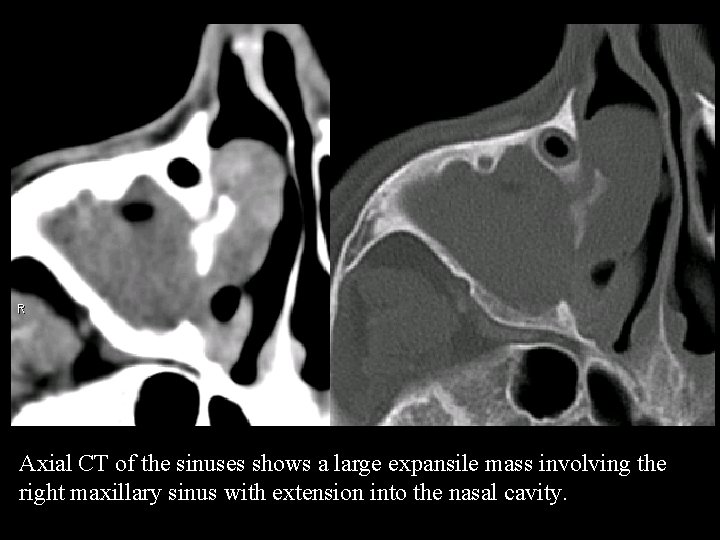 Axial CT of the sinuses shows a large expansile mass involving the right maxillary
