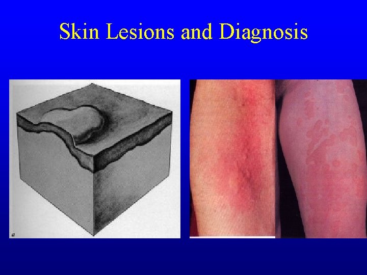 Skin Lesions and Diagnosis Skin Lesions and Diagnosis