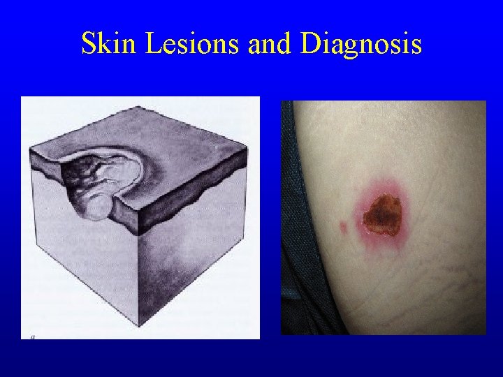 Skin Lesions and Diagnosis Skin Lesions and Diagnosis