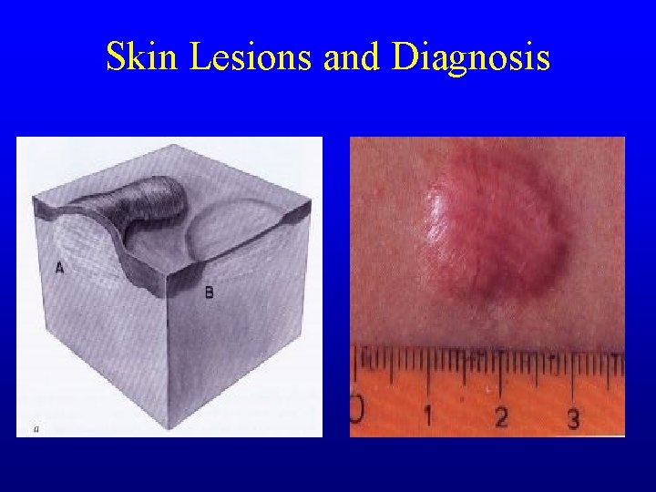 Skin Lesions and Diagnosis Skin Lesions and Diagnosis