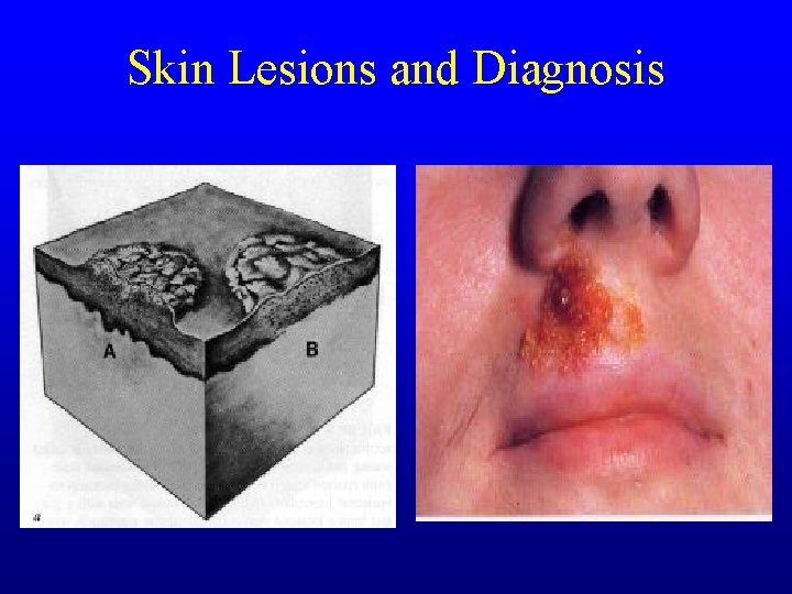 Skin Lesions and Diagnosis Skin Lesions and Diagnosis