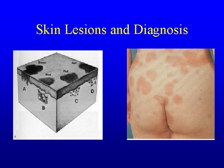 Skin Lesions and Diagnosis Skin Lesions and Diagnosis
