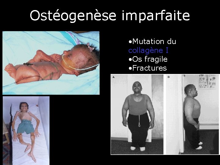 Ostéogenèse imparfaite • Mutation du collagène I • Os fragile • Fractures 59 