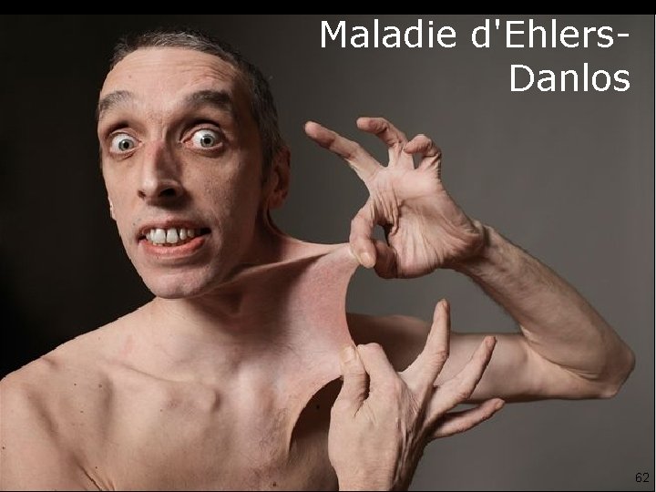 Maladie d'Ehlers. Danlos 62 