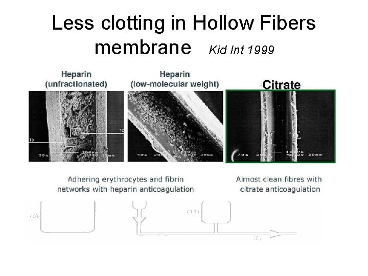 Less clotting in Hollow Fibers membrane Kid Int 1999 