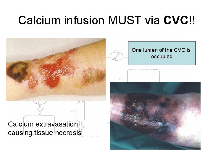 Calcium infusion MUST via CVC!! One lumen of the CVC is occupied Calcium extravasation