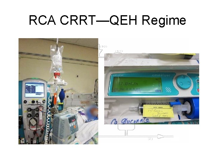 RCA CRRT—QEH Regime 