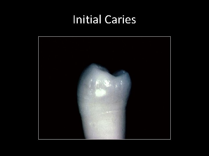 Initial Caries 