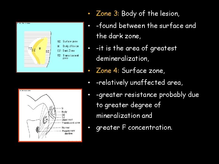  • Zone 3: Body of the lesion, • -found between the surface and