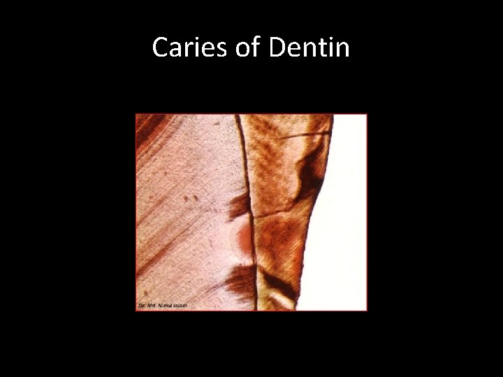 Caries of Dentin 