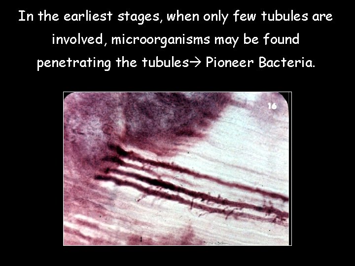 In the earliest stages, when only few tubules are involved, microorganisms may be found