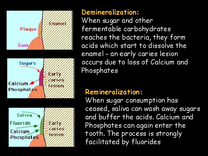 Demineralization: When sugar and other fermentable carbohydrates reaches the bacteria, they form acids which