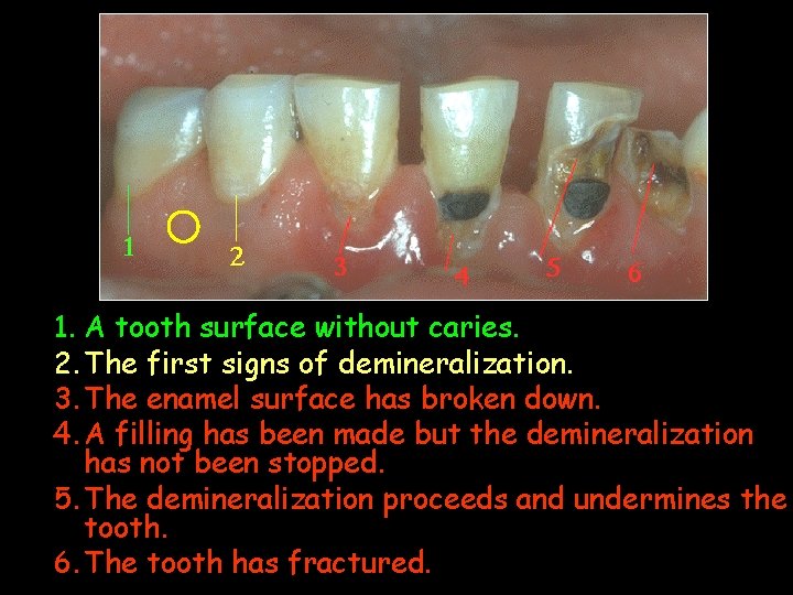 1. A tooth surface without caries. 2. The first signs of demineralization. 3. The