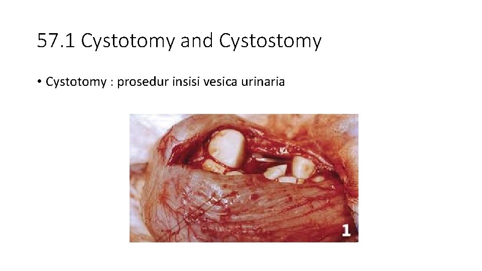 57. 1 Cystotomy and Cystostomy • Cystotomy : prosedur insisi vesica urinaria 