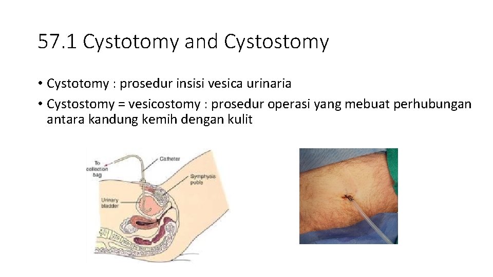 57. 1 Cystotomy and Cystostomy • Cystotomy : prosedur insisi vesica urinaria • Cystostomy