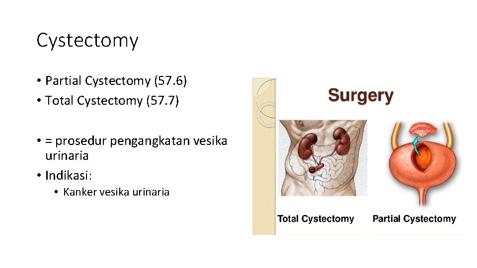 Cystectomy • Partial Cystectomy (57. 6) • Total Cystectomy (57. 7) • = prosedur