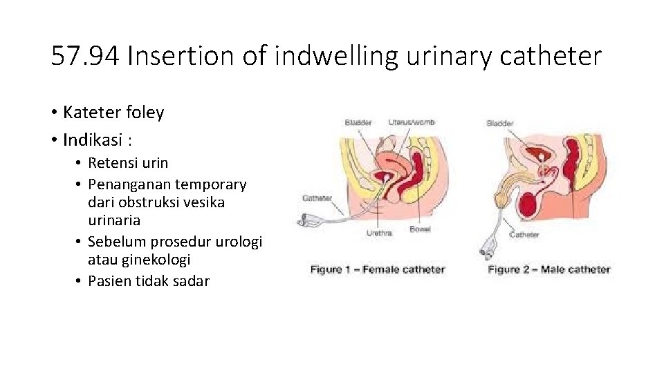 57. 94 Insertion of indwelling urinary catheter • Kateter foley • Indikasi : •