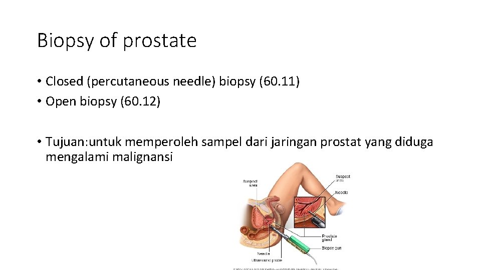 Biopsy of prostate • Closed (percutaneous needle) biopsy (60. 11) • Open biopsy (60.