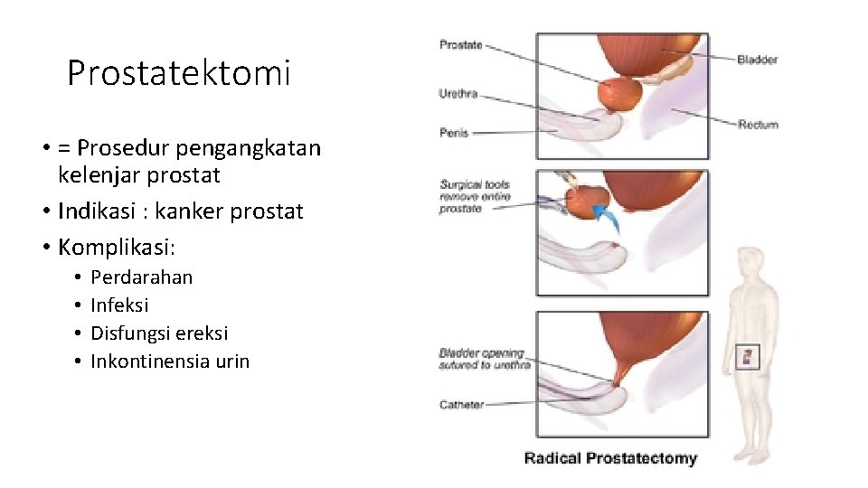 Prostatektomi • = Prosedur pengangkatan kelenjar prostat • Indikasi : kanker prostat • Komplikasi: