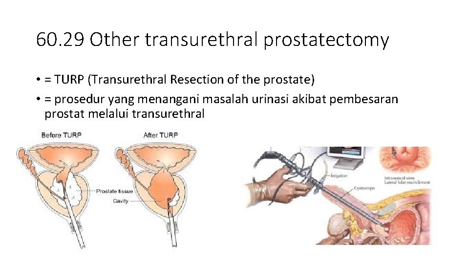 60. 29 Other transurethral prostatectomy • = TURP (Transurethral Resection of the prostate) •