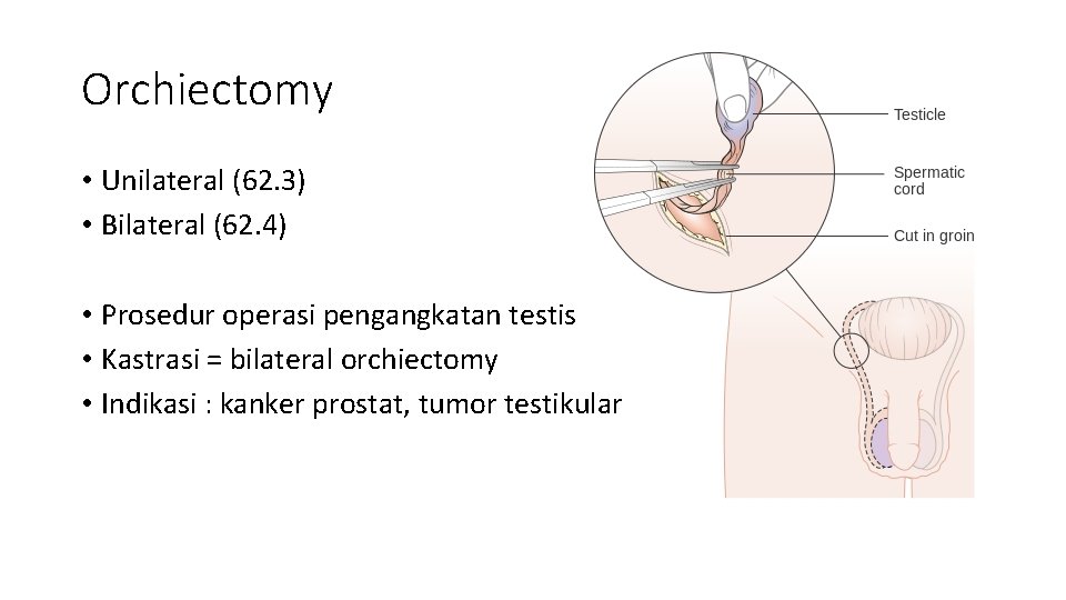 Orchiectomy • Unilateral (62. 3) • Bilateral (62. 4) • Prosedur operasi pengangkatan testis