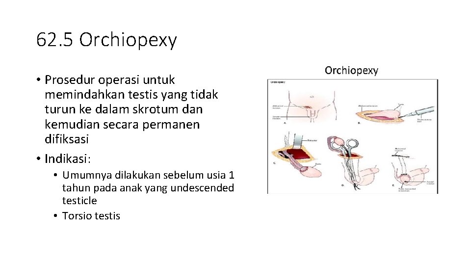 62. 5 Orchiopexy • Prosedur operasi untuk memindahkan testis yang tidak turun ke dalam