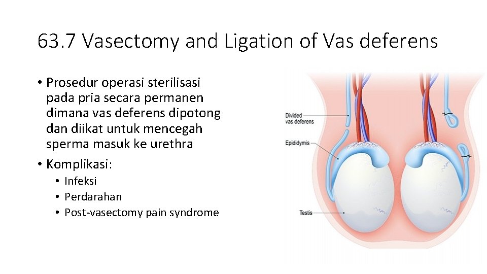 63. 7 Vasectomy and Ligation of Vas deferens • Prosedur operasi sterilisasi pada pria