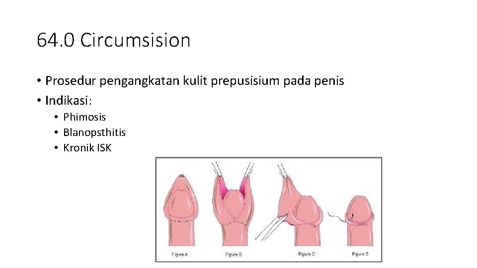 64. 0 Circumsision • Prosedur pengangkatan kulit prepusisium pada penis • Indikasi: • Phimosis