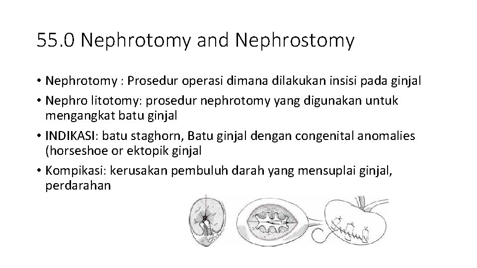 55. 0 Nephrotomy and Nephrostomy • Nephrotomy : Prosedur operasi dimana dilakukan insisi pada