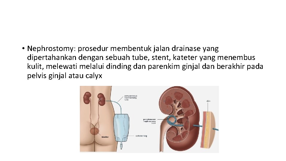  • Nephrostomy: prosedur membentuk jalan drainase yang dipertahankan dengan sebuah tube, stent, kateter