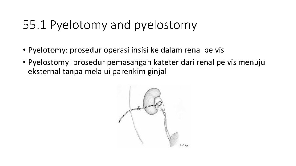 55. 1 Pyelotomy and pyelostomy • Pyelotomy: prosedur operasi insisi ke dalam renal pelvis