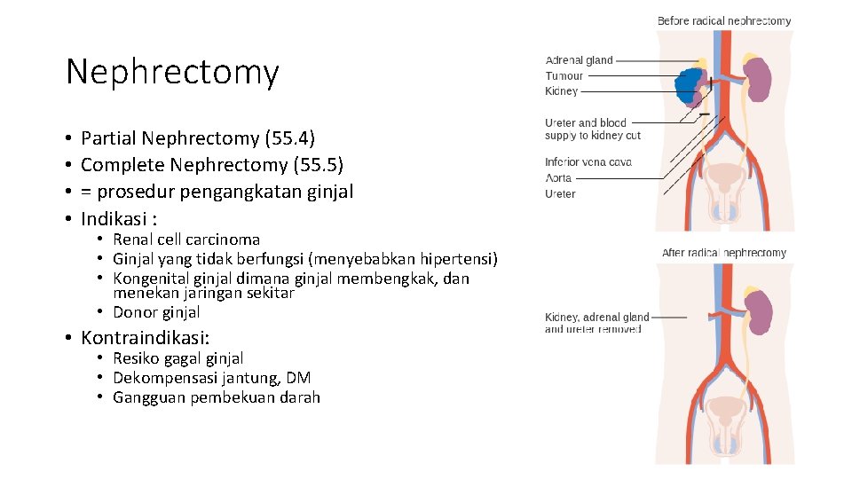 Nephrectomy • • Partial Nephrectomy (55. 4) Complete Nephrectomy (55. 5) = prosedur pengangkatan