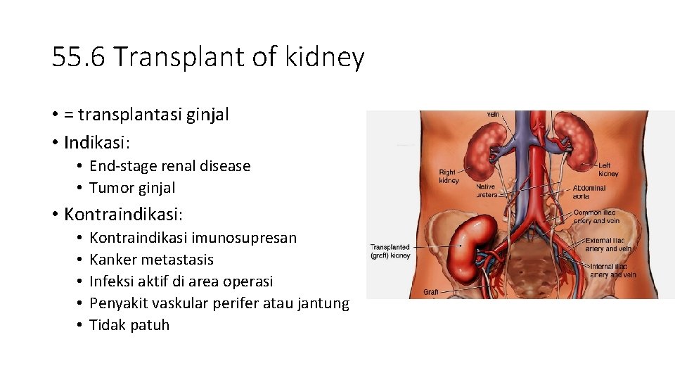 55. 6 Transplant of kidney • = transplantasi ginjal • Indikasi: • End-stage renal
