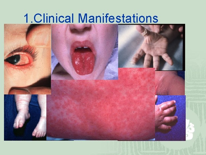 1. Clinical Manifestations 
