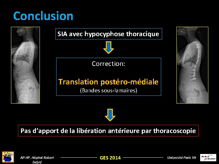 Conclusion SIA avec hypocyphose thoracique Correction: Translation postéro-médiale (Bandes sous-lamaires) Pas d’apport de la Conclusion SIA avec hypocyphose thoracique Correction: Translation postéro-médiale (Bandes sous-lamaires) Pas d’apport de la