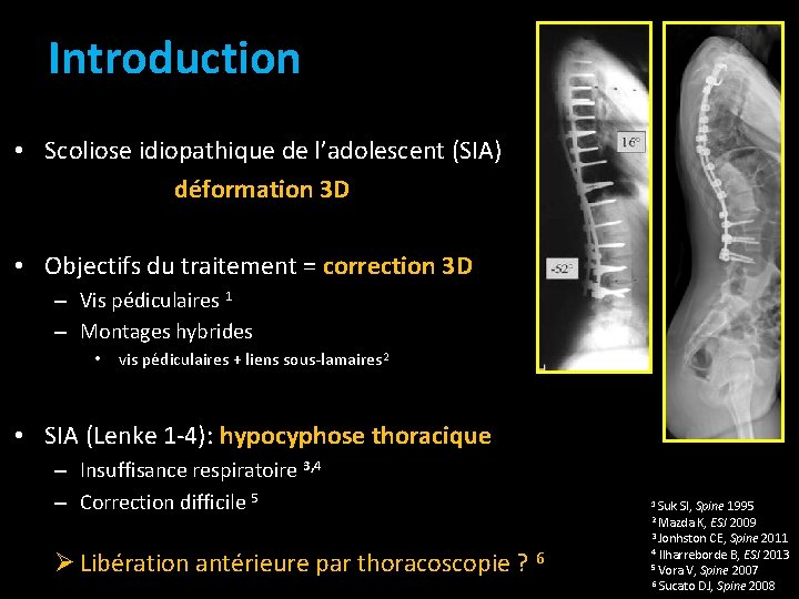 Introduction • Scoliose idiopathique de l’adolescent (SIA) déformation 3 D • Objectifs du traitement Introduction • Scoliose idiopathique de l’adolescent (SIA) déformation 3 D • Objectifs du traitement