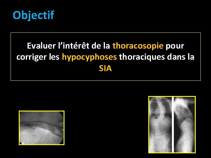 Objectif Evaluer l’intérêt de la thoracosopie pour corriger les hypocyphoses thoraciques dans la SIA Objectif Evaluer l’intérêt de la thoracosopie pour corriger les hypocyphoses thoraciques dans la SIA