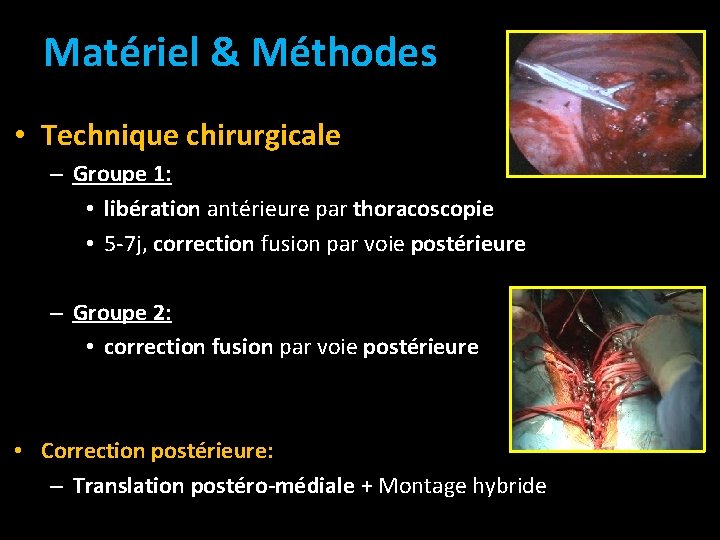 Matériel & Méthodes • Technique chirurgicale – Groupe 1: • libération antérieure par thoracoscopie Matériel & Méthodes • Technique chirurgicale – Groupe 1: • libération antérieure par thoracoscopie