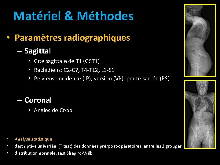 Matériel & Méthodes • Paramètres radiographiques – Sagittal • Gîte sagittale de T 1 Matériel & Méthodes • Paramètres radiographiques – Sagittal • Gîte sagittale de T 1