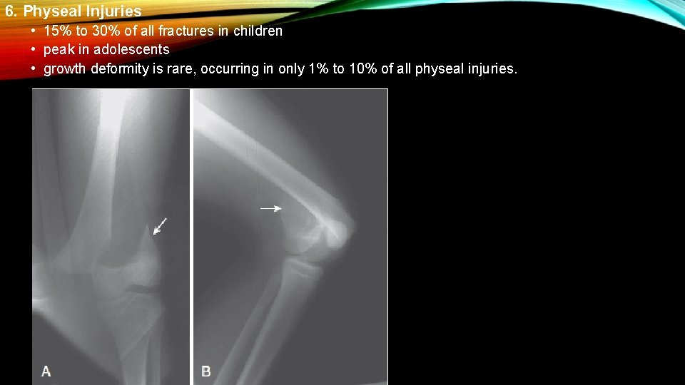 6. Physeal Injuries • 15% to 30% of all fractures in children • peak 6. Physeal Injuries • 15% to 30% of all fractures in children • peak