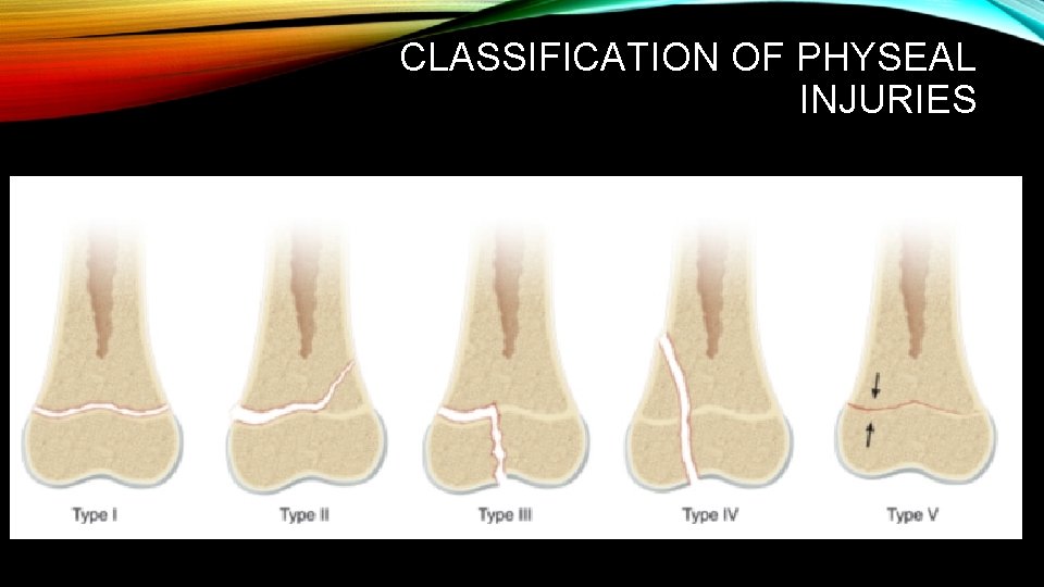 CLASSIFICATION OF PHYSEAL INJURIES CLASSIFICATION OF PHYSEAL INJURIES