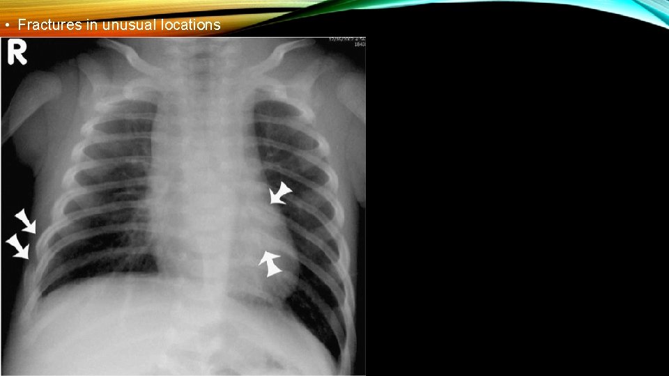 • Fractures in unusual locations • Fractures in unusual locations