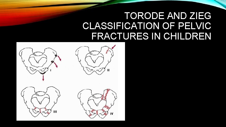 TORODE AND ZIEG CLASSIFICATION OF PELVIC FRACTURES IN CHILDREN TORODE AND ZIEG CLASSIFICATION OF PELVIC FRACTURES IN CHILDREN