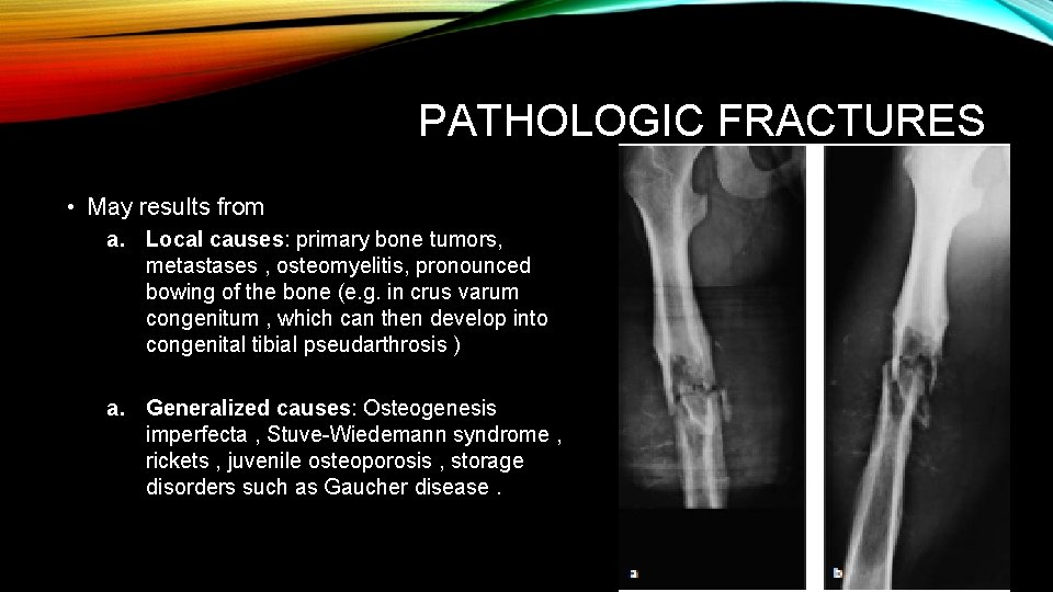 PATHOLOGIC FRACTURES • May results from a. Local causes: primary bone tumors, metastases , PATHOLOGIC FRACTURES • May results from a. Local causes: primary bone tumors, metastases ,